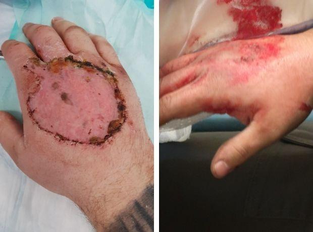 Dudley News: The hand injury after the skin graft as it healed, and when it first happened on December 11